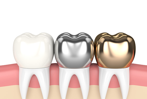 Dental Crown