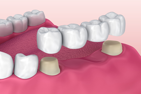 Dental Bridge