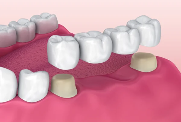 Dental Bridge