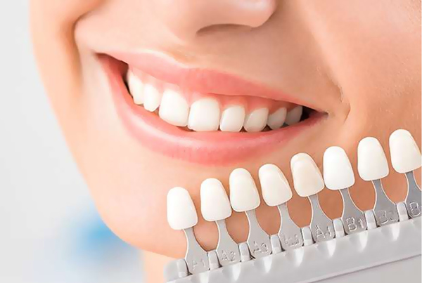 Dental Veneers