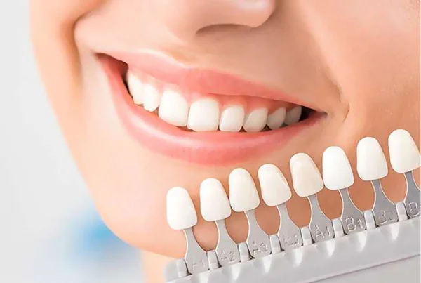 Dental Veneers