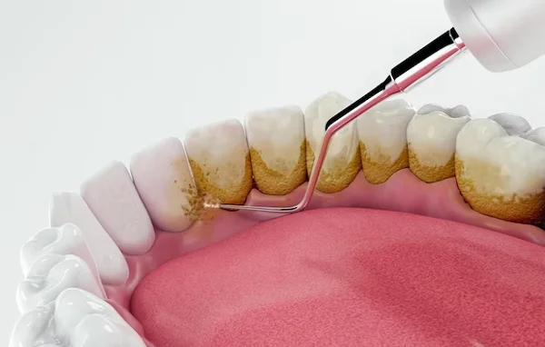 Teeth Cleaning