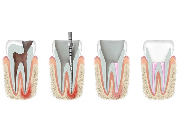 Root Canal Therapy