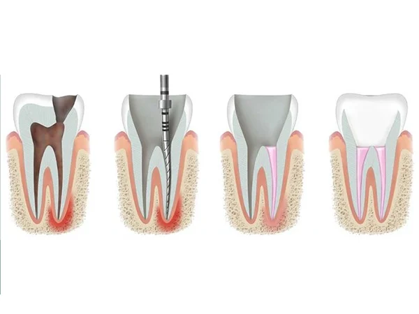 Root Canal Therapy