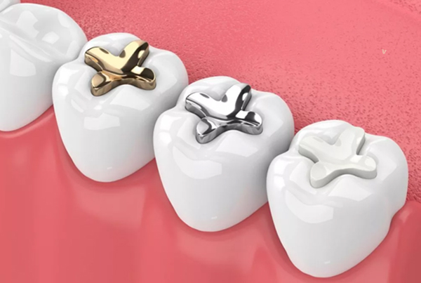 Dental Sealants