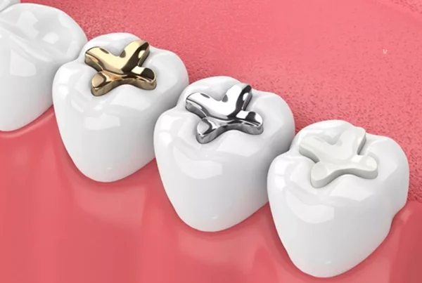 Dental Sealants